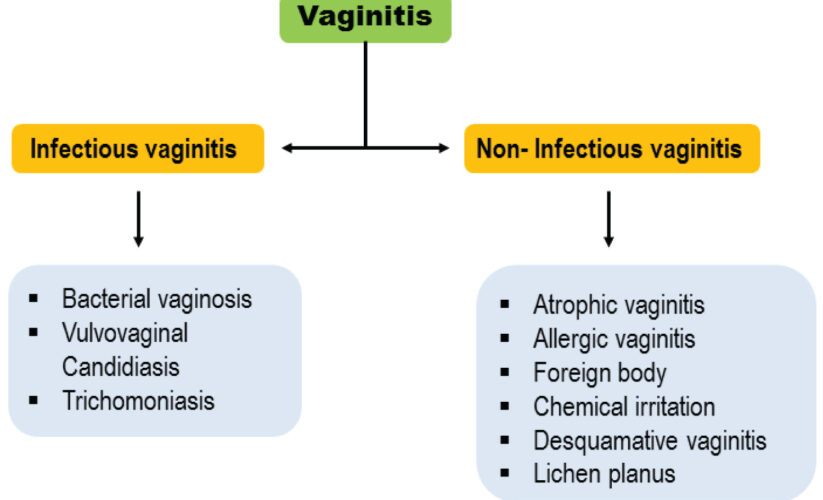 Discover How Stress Can Impact Bacterial Vaginosis: An Essential Guide for 2025